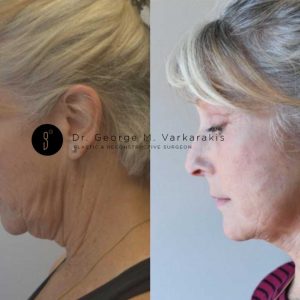 Neck Lift Miami